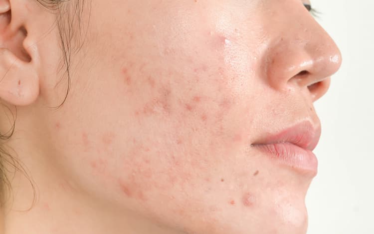 Come eliminare le cicatrici da acne